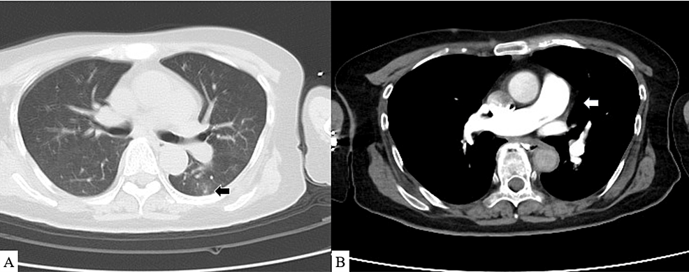 CT findings on 1st day. (A) Black arrow: pulmonary ground-glass opacity is observed. (B) White arrow: no contrast deficit is observed in the pulmonary artery.